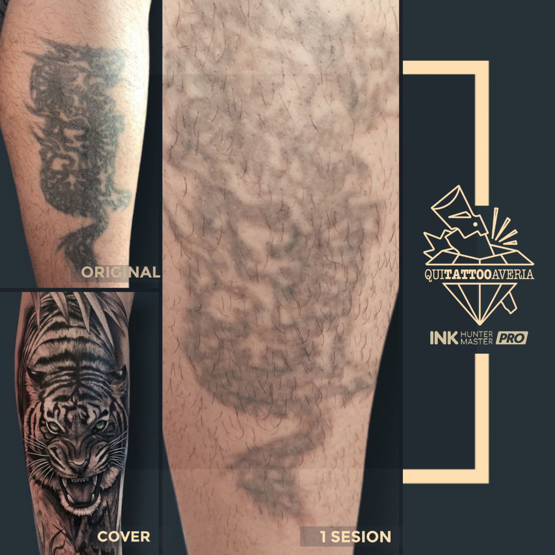 eliminar-tatuajes-con-laser-cover